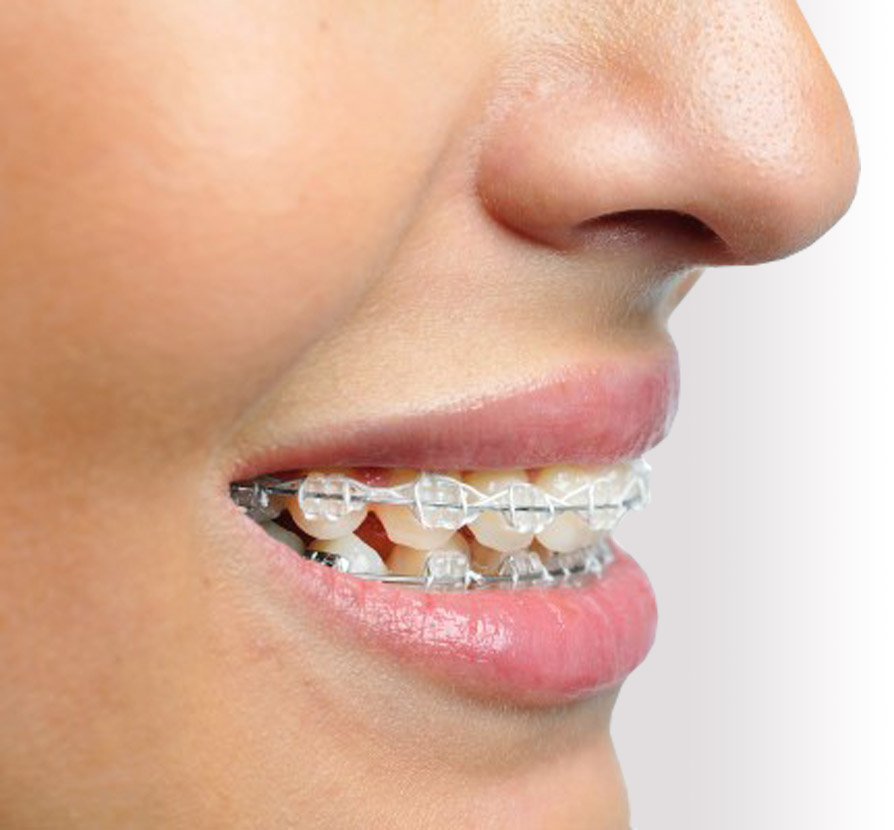  What are the benefits of clear braces?