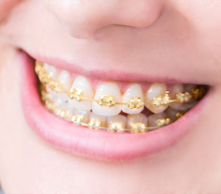 Gold Braces Aesthetic Braces in Narellan Harris Orthodontics