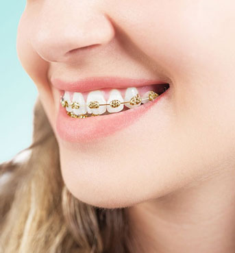 Gold braces