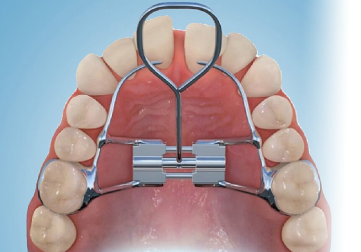  Palatal expander