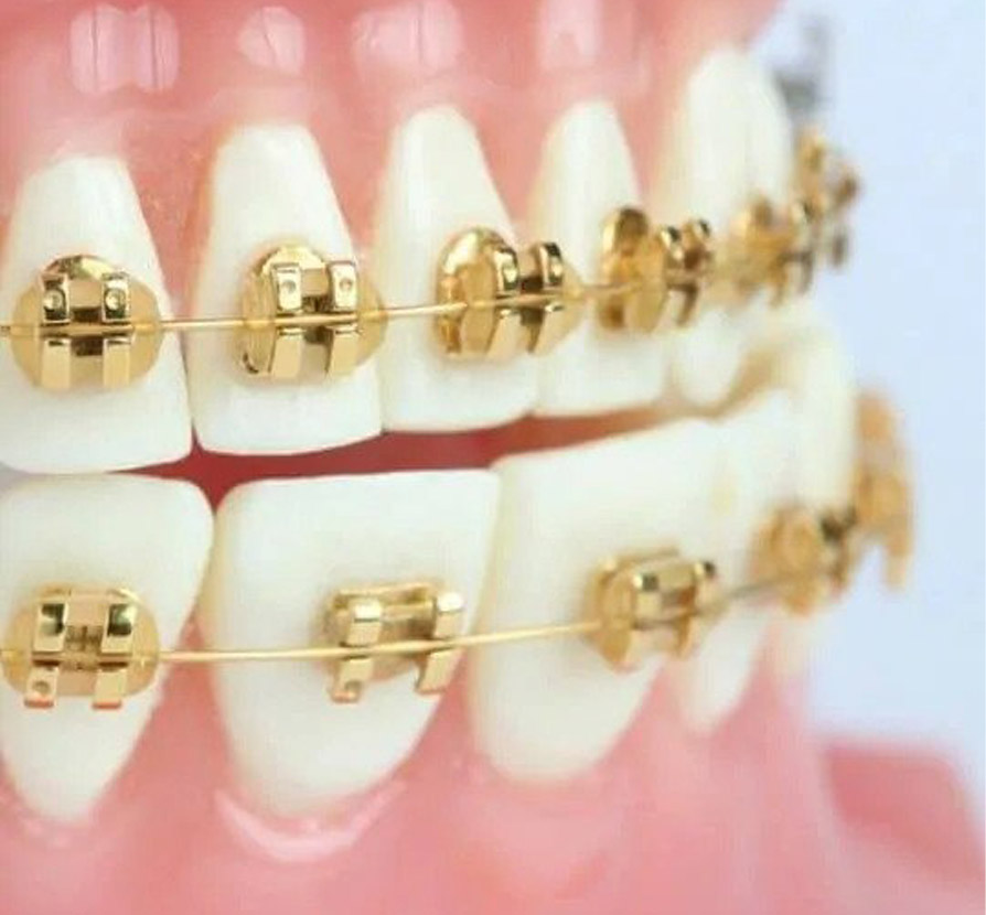  Why should I choose gold braces?