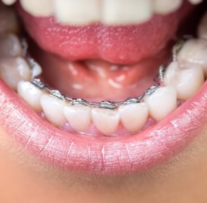  How do lingual braces work?