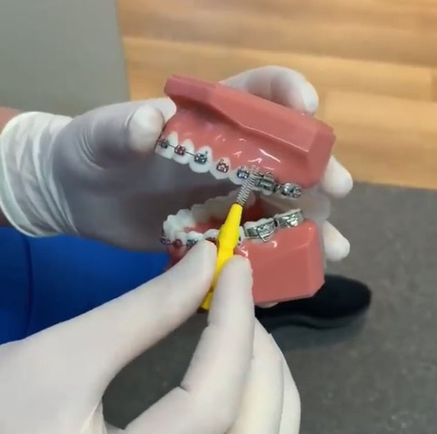  How do metal braces work?