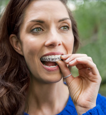 Invisalign® FAQs