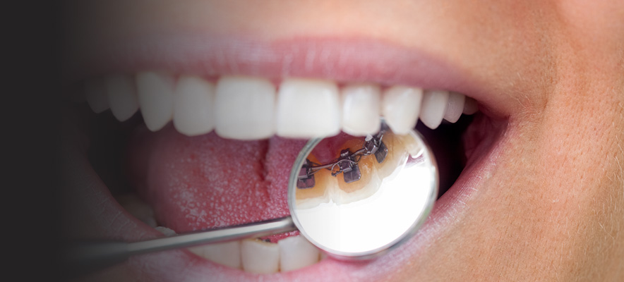 Lingual Braces –